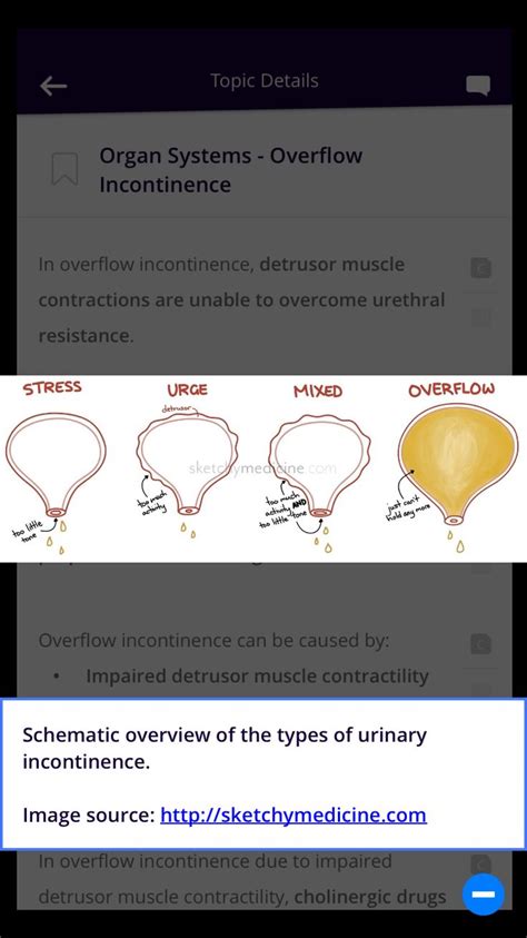 Overflow incontinence treatment guidelines - indyshery