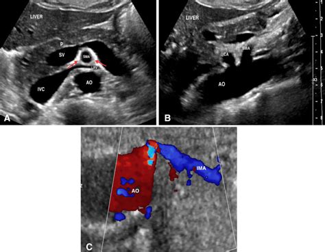 Anatomic Landmarks Of The Mesenteric Arteries Gray Scale Images