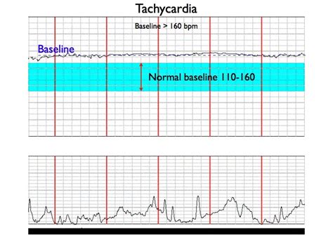 Basic Pattern Recognition Electronic Fetal Monitoring