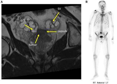 Frontiers Rationale For Stereotactic Body Radiation Therapy In Treating Patients With