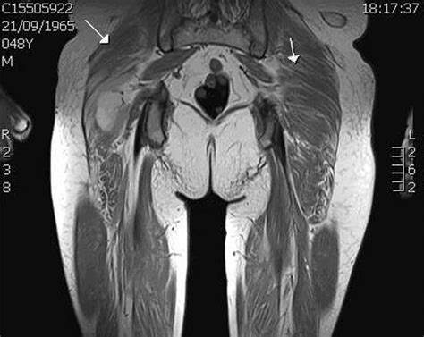 Resonancia Magnetica De Pelvis