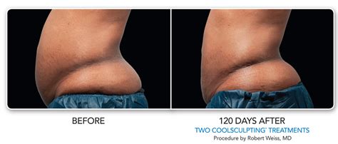 Coolsculpting Non Surgical Fat Reduction Medspa Chicago Il