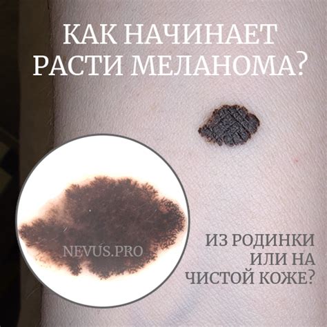 Как начинает расти меланома? Из родинки или на коже? — nevus.pro