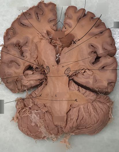 Neuroanatomy Lab Practical 2 Labeling Frontal Section Diagram Quizlet