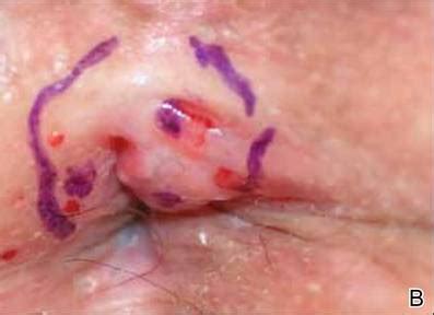 Squamous Cell Carcinoma Of The Anus Telegraph