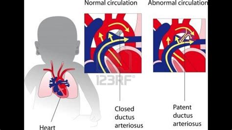 Audio Heart Sound Of Patent Ductus Arteriosus Pda Usmle Real Time