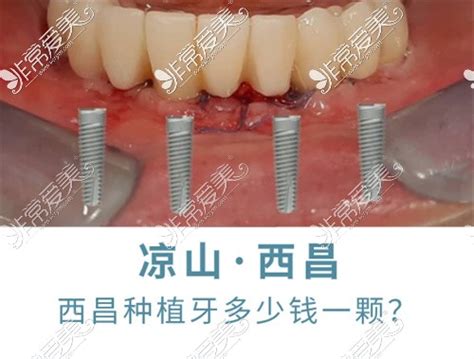 凉山西昌种植牙多少钱一颗对比2021西昌种植牙价格便宜吗 非常爱美