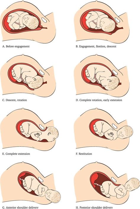 Related Image Accouchement Gynécologie Obstétrique L Accouchement