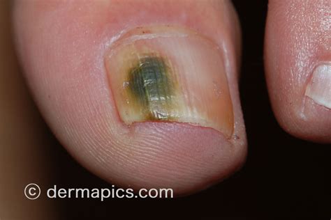 Nail Infection Pictures Pictures Photos