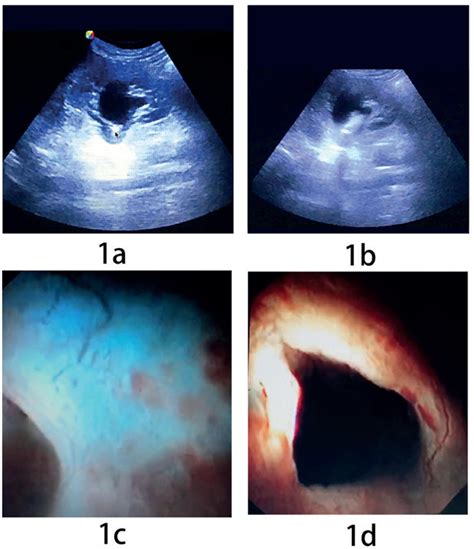 Scielo Brasil Simultaneous Treatment Of Parapelvic Renal Cysts And