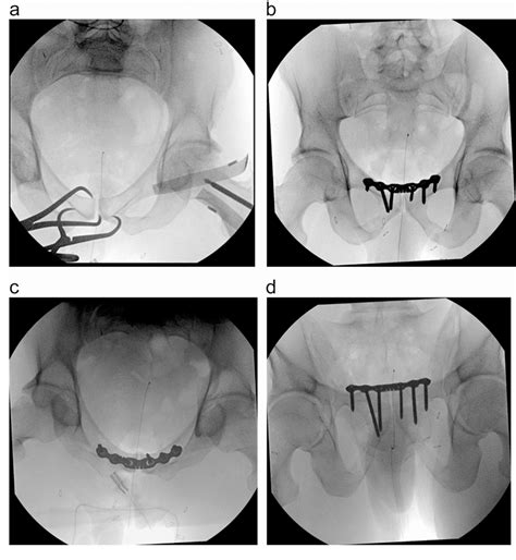 Obturator Dislocations Of The Hip Associated With Pelvic Ring Injuries