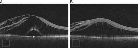 Optic Disc Pit Maculopathy Fraenkel 2018 Clinical And Experimental Optometry Wiley