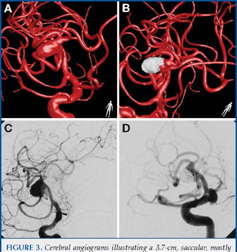 Figure From Management Of Giant Middle Cerebral Artery Aneurysms With