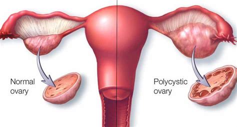 Pcos Symptoms Are Often Misdiagnosed Signs That You Have This Condition