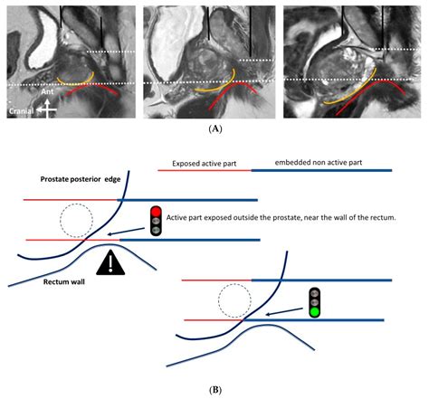 Geometric Anatomy Basis For Safe And Effective Focal Ablation Of