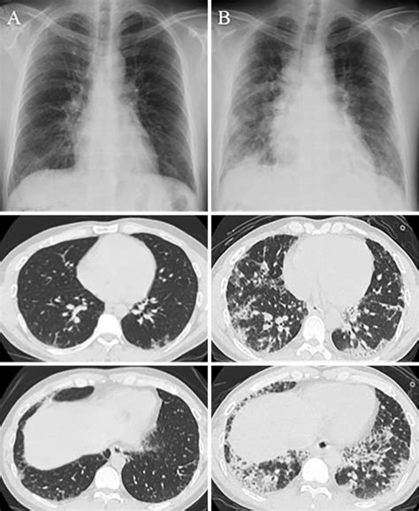 Figure High Resolution Computed Tomography Hrct Images Of The