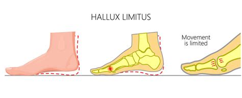 Hallux Limitus Rigidus Advanced Foot Care