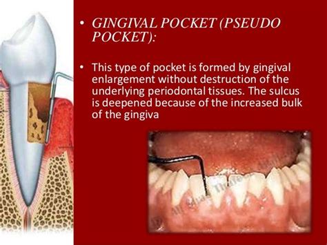 Periodontal Pockets