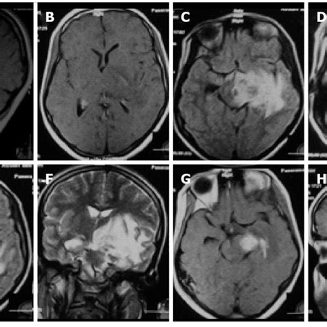 Cranial Magnetic Resonance Imaging Brain On Admission At September