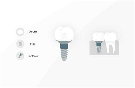 Partes De Un Implante Dental Todo Lo Que Debes Saber