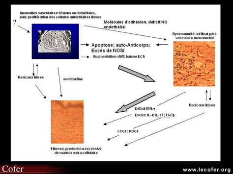 Scl Rodermie Syst Mique Atteinte Vasculaire P Riph Rique De La