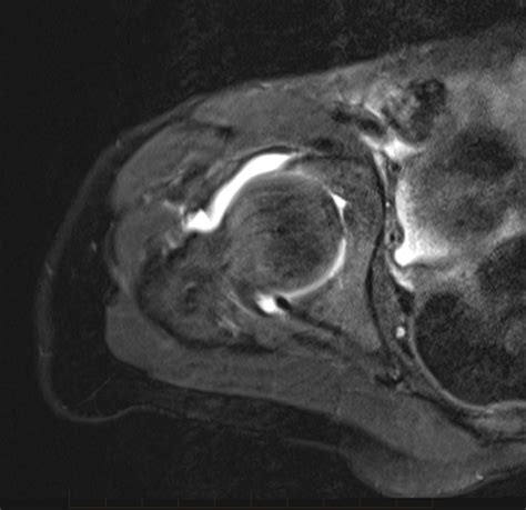 Mri Hip Paediatic Mri Series Gp Referred