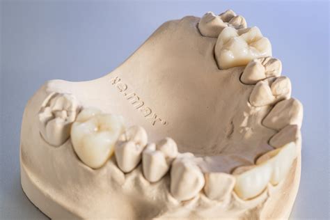 Ips Emax® Ceramic Crowns For A Natural Looking Restoration Precision