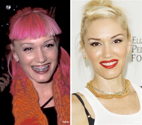 Gwen Stefani S Journey To A Perfect Smile Smile Makeover Smile Dailybeauty The Beauty