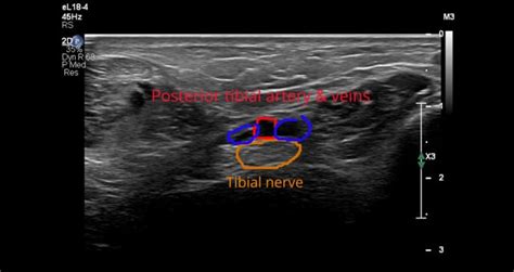 Ankle Normal ULTRASOUNDPAEDIA