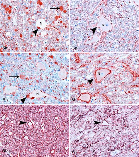 And Axonal Spheroids Nucleus Lateralis Immunohistochemistry For