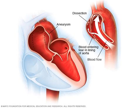 Aortic dissection and aortic aneurysm - Mayo Clinic