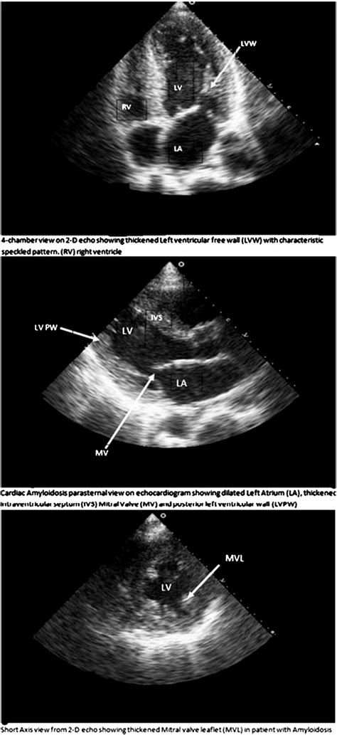 The Amazing Cardiac Amyloidosis Ekg And Echocardiogram International