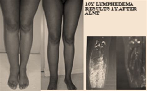 Congenital Lymphedema Dr Corinne Becker Lymphoedema Center