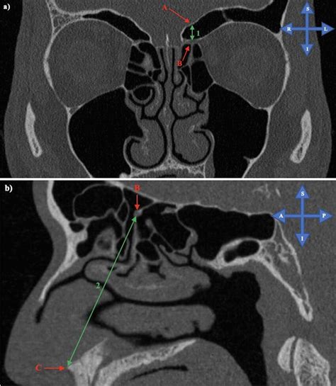 a Measurement of the vertical distance from the anterior ethmoidal ...