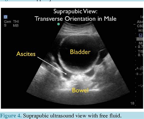 Ascites Liver Ultrasound