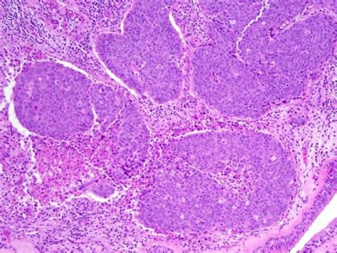 Nut Carcinoma A Rare And Devastating Neoplasm Bmj Case Reports