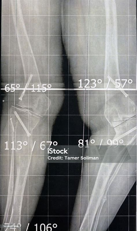 Plain X Ray Long Film Standing Position Showing Both Legs With