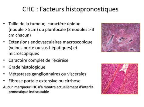 Ppt Carcinome H Patocellulaire Aspects Anatomopathologiques Amir