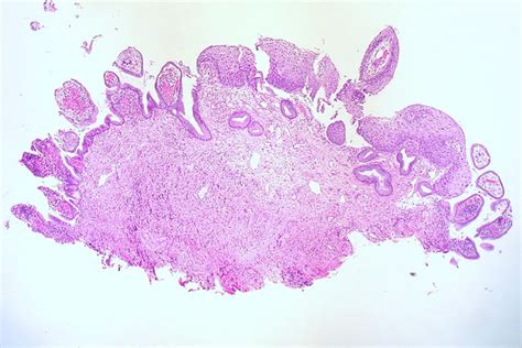 Lsil Cin 1 Cervical Biopsy Ed Uthman Flickr