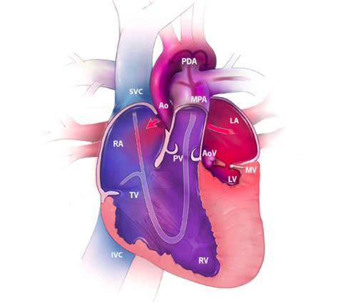 Hypoplastisches Linksherzsyndrom HLHS E Learning Mit Lecturio