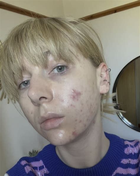 Finished Accutane - before / after, skincare products and tips : r/Accutane