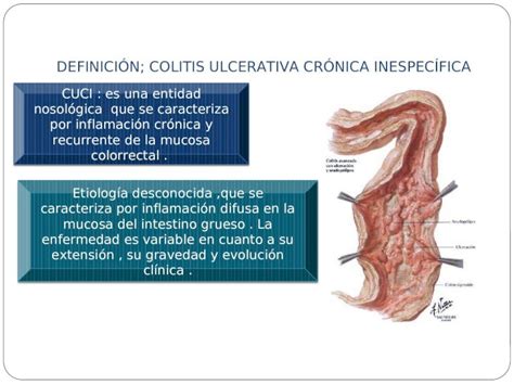 Ppt Definici N Colitis Ulcerativa Cr Nica Inespec Fica Cuci Es Una