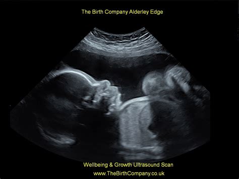 Fetal Wellbeing Growth Scan 190 Alderley Edge Cheshire The