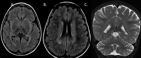 Multiple Cranial Nerve Enhancement In A Case Of Neuronal Ceroid