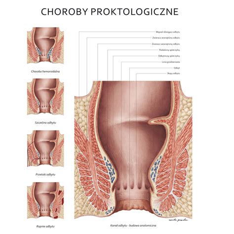 Choroby Odbytu Plakat Marta Pawelec