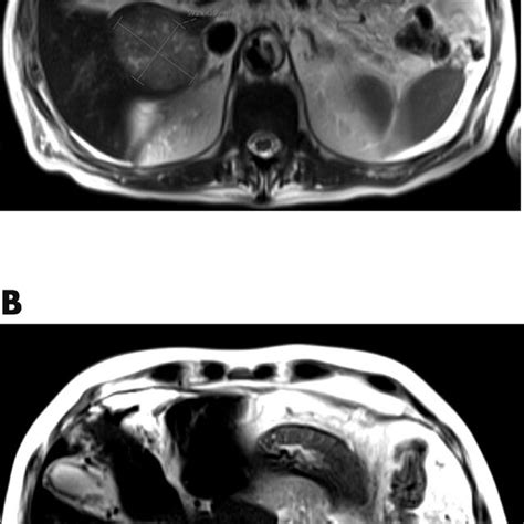 Mri Liver With Intravenous Gadolinium Contrast On Axial T Sequence