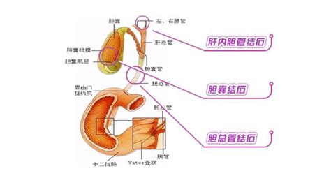 胆囊炎的症状图片 胆囊炎图片大全 胆囊炎 39疾病百科