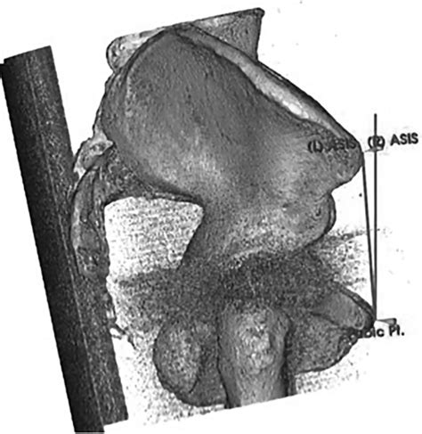 Functional Acetabular Component Position With Supine Total Hip