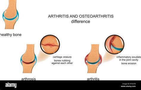 Vector Illustration Of The Difference Between Arthrosis And Arthritis Stock Vector Image And Art