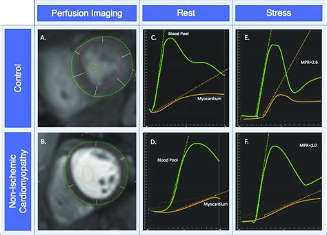 Determining Myocardial Perfusion Reserve Index Panel A B First Pass